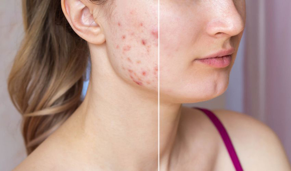 distinct-kinds-of-acne